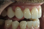 Figure 5  Bonded ceramic restorations shouldfilter underlying color while allowing light to circulatefreely within the tooth.