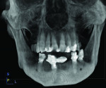 Additional views from CBCT scan at 6 months post-treatment demonstrating osseous fill and integration of implants.