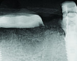 Periapical radiograph 6 months after grafting demonstrating complete bone fill of the large defect with NovaBone graft.