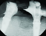 Periapical radiographs 3 weeks after grafting demonstrating initial organization of the NovaBone graft in the large osseous defect.