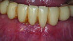 Healthy soft tissue adjacent to the screw-retained fixed provisional prosthesis 6 months after grafting.