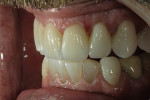 Figure 9  Even though a relatively translucent ceramic is used, the extra thickness of ceramic in discolored areas effectively filters undesirable color. Empress TC0 ingot was used here.
