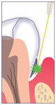 The Nd:YAG laser removes the diseased epithelial lining and improves access to the root surface.