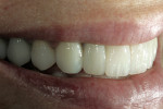 Figure 11a  A pressable ceramic was used over the zirconia substructure to achieve an esthetic result.