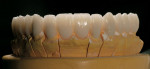 Figure 11b  A pressable ceramic was used over the zirconia substructure to achieve an esthetic result.
