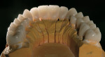 Figure 11c  A pressable ceramic was used over the zirconia substructure to achieve an esthetic result.