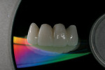Figure 11d  A pressable ceramic was used over the zirconia substructure to achieve an esthetic result.