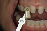 Figure 12  When underlying tooth color isgood, less reduction is necessary.