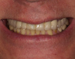 Fig 1 through Fig 3. Patient presents with restorations deemed esthetically unacceptable.