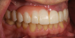Fig 13 and Fig 14. The wax-up was transferred to the patient via a putty matrix as a provisional to evaluate esthetic and functional parameters.