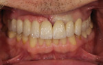 Fig 19 and Fig 20. A try-in of the cast framework to evaluate the gingival color and position.