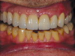 Fig 21 through Fig 25. The final restoration is inserted and cemented and found acceptable by the patient and dental team.