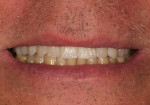 Fig 19 and Fig 20. A try-in of the cast framework to evaluate the gingival color and position.