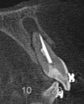 Figure 5 Tomographic examination of the maxillary left central incisor showing appellant periapical lesion.