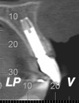 Figure 16 Tomographic view of the maxillary
right central incisor after 3 years of follow-up.