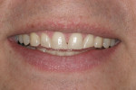 Preoperative smile. Note wear on all of the anterior teeth, most notably the tips of
the maxillary and mandibular canines.