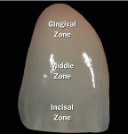 Figure 3  Image of a natural tooth that shows the 3 basic zones of color.
