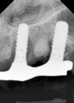 Pretreatment periapical radiograph of peri-implantitis defects present.