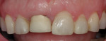 Close-up view of the patient’s anterior teeth following crown lengthening.