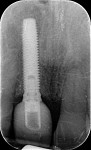 Radiograph taken immediately following implant placement with provisional abutment and crown.