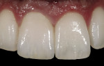 Figure 14  Postoperative view of the spinell VM7 crown on tooth No. 8.