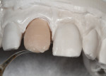 Fig 3. A wax-up of the coping was created.