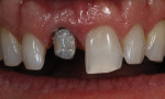Fig 1. The author noted the dark color of tooth No. 8 stump when the temporary restoration was removed.