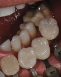 Fig 17. Custom shade tabs were used to assess color harmony with mandibular teeth.