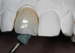 Fig 18 and Fig 19. The crown was placed on the die to grind away the incisal one-third.