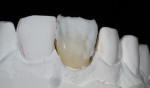 Fig 24 and Fig 25. TMO 5 and TMO 4 were added for improved color matching harmony and a pinkish tone to the gingival area.
