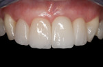 Figure 25 Final restorations 7 months after cementation of the crowns.