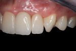 Figure 26 Final restorations 7 months after cementation of the crowns.