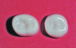 Mandibular right primary first molar crown (left) and maxillary left primary first molar crown (right).