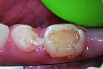 Mandibular right primary molars before treatment.