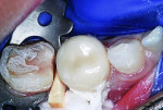 UL6 zirconia crown luted using resin-modified glass ionomer cement.