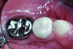 Left primary molars, 14 months after treatment.