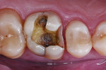 Caries excavation and cavity preparation.