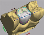 Figure 1  The CEREC<sup>®</sup> 3D design software, used chairside by dentists and auxiliaries in the design of inlay, onlay, partial crown, full crown, and veneer ceramic restorations.