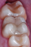 Final result from mesial view.