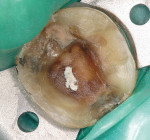 Figure 2 Tooth preparation of the failed onlay is isolated with a rubber dam.