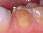 Figure 5 Preparations for porcelain veneers that de-bonded approximately 5 years after placement. The preparations are largely in dentin. The luting resin was left on the inner surface of the veneers, indicating failure of the adhesive interface with
