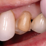 Figure 6 Preparations for porcelain veneers that de-bonded approximately 5 years after placement. The preparations are largely in dentin. The luting resin was left on the inner surface of the veneers, indicating failure of the adhesive interface with