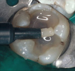 Figure 7 A heavily filled composite restorative is placed over a thin layer of translucent shade flowable. A dentin bonding agent was placed and cured prior to placement of the flowable composite.
