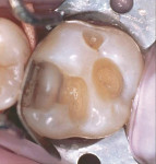 Figure 9 Box areas in Class II restorations and locations where the external preparation margin ends in dentin and/or cementum are particularly vulnerable to microleakage. In this preparation, Vitrebond has been placed in the box area prior to treatm