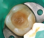 Figure 10 In this very deep preparation, virtually all of the exposed dentin has been covered with the resin-modified glass ionomer prior to placing the adhesive system.