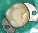 Figure 11 In this very deep preparation, virtually all of the exposed dentin has been covered with the resin-modified glass ionomer prior to placing the adhesive system.