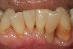 After placement of a direct composite, fiber-reinforced fixed bridge, the missing tooth was restored in one appointment, with very little sacrifice to tooth structure and with a substantial savings in cost both to the doctor and patient.