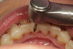 A lingual view of the placement procedure for everStickPerio being used as lingual fixed retention after completion of orthodontic treatment. With composite, fiber-reinforced fixed bridge, the missing tooth was restored in one appointment, with very little sacrifice to tooth structure and with a substantial savings in cost both to the doctor and patient.