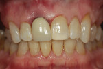 After the crown had the root resected, it was reattached to the abutment teeth using composite resin reinforced with everStickC&B. This shows postoperative results.