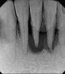 Case 2 pretreatment radiograph showing more than 9-mm probing depth on all aspects of teeth Nos. 24 and 25.